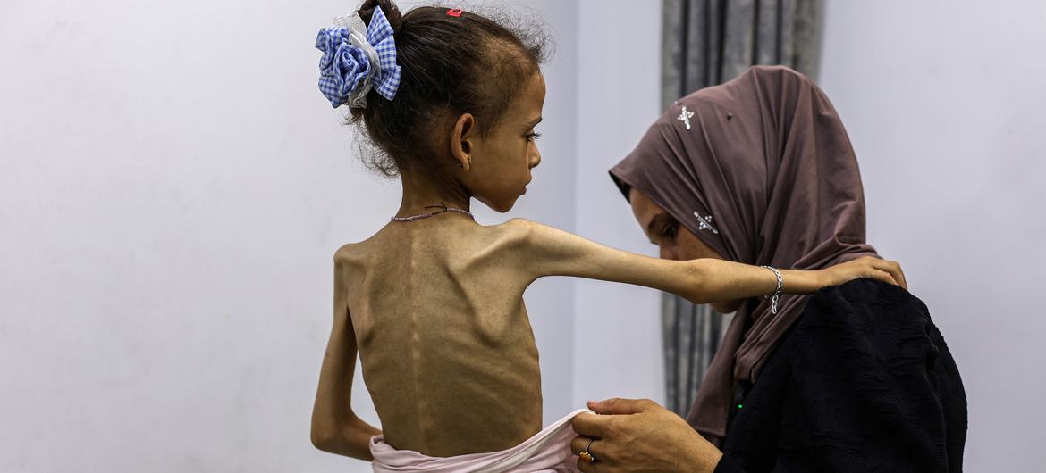 A severely malnourished girl in Gaza (WHO)
